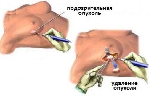 Секторальная резекция молочной железы. Что это такое, восстановление
