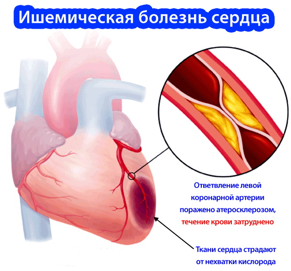 Реваскуляризация миокарда коронарная. Что это такое