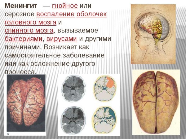 Менингит у детей 5-10 лет. Симптомы, как проявляется