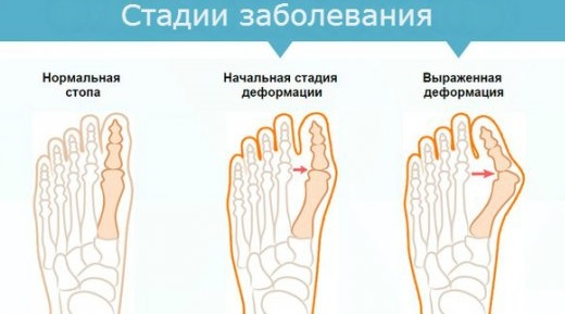 Как снять усталость ног после работы, длительной ходьбы