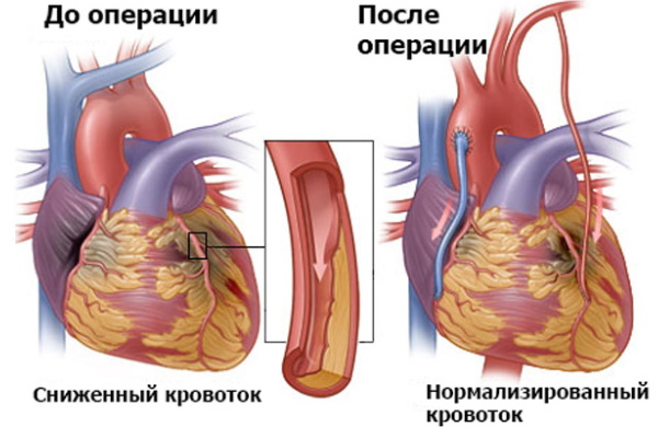 Реваскуляризация миокарда коронарная. Что это такое