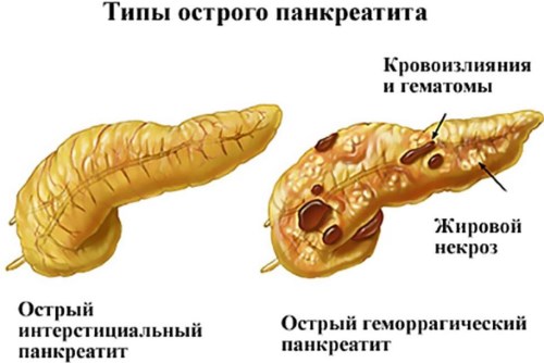Симптомы боли поджелудочной железы. Признаки панкреатита, лечение поджелудочной железы