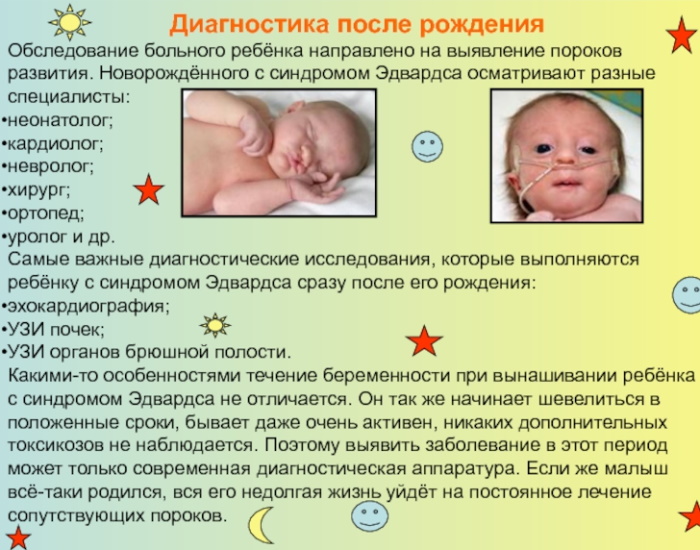 Синдром Эдвардса. Что это такое, причины, кариотип, симптомы, лечение