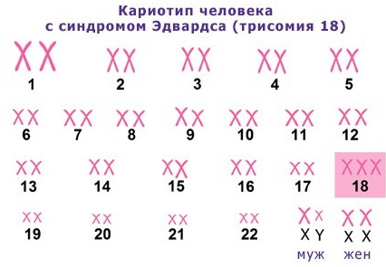 Синдром Эдвардса. Что это такое, причины, кариотип, симптомы, лечение