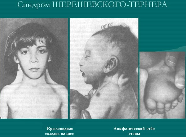 Наследственные болезни человека. Список с описанием, таблица