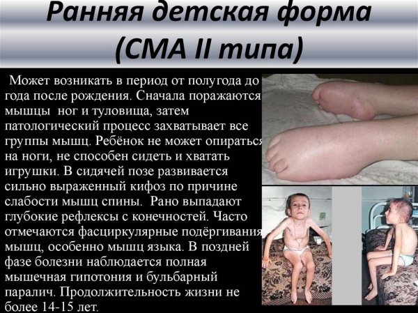 Спинально-мышечная атрофия у детей, взрослых. Что это такое, симптомы, лечение, клинические рекомендации