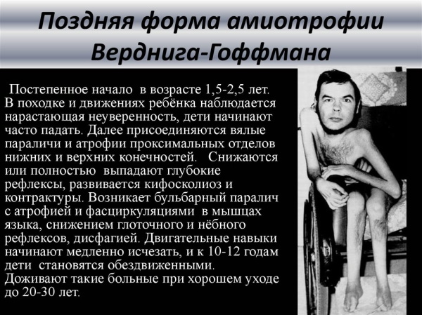 Спинально-мышечная атрофия у детей, взрослых. Что это такое, симптомы, лечение, клинические рекомендации