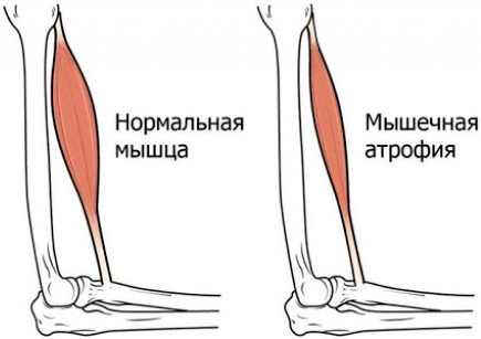 Спинально-мышечная атрофия у детей, взрослых. Что это такое, симптомы, лечение, клинические рекомендации