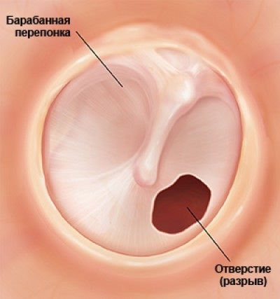 Стук в ухе без боли. Что это такое, причины, что делать, лечение
