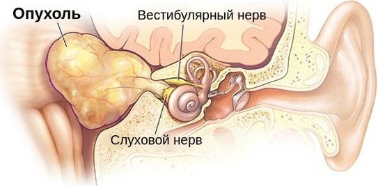 Стук в ухе без боли. Что это такое, причины, что делать, лечение