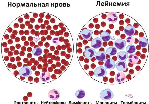 Синдром Дауна. Фото взрослых, детей, кариотип, причины, симптомы, признаки, лечение, диагностика, риск