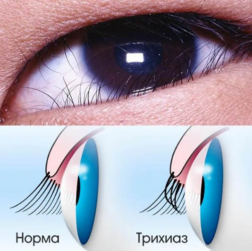 Трихиаз (неправильный рост ресниц). Что это, лечение