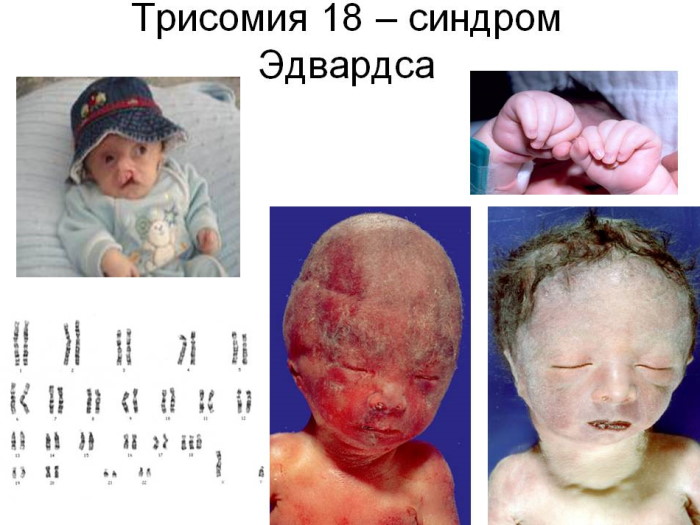 Трисомия 21.18.13: норма в 1 триместре у беременных