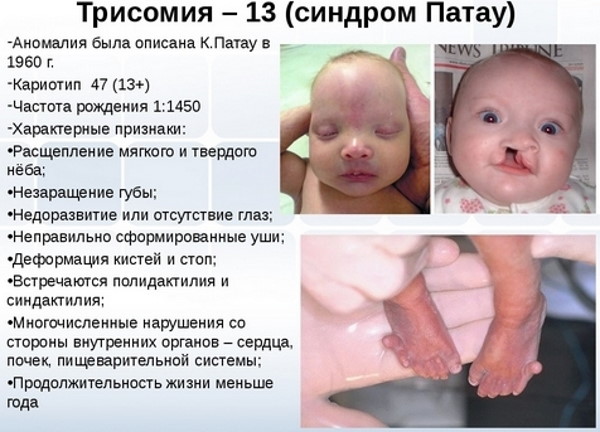 Трисомия 21.18.13: норма в 1 триместре у беременных