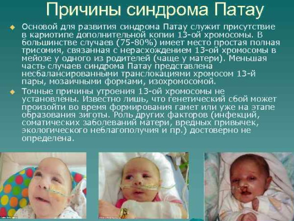 Трисомия 21.18.13: норма в 1 триместре у беременных