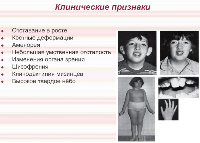 Трисомия по X-хромосоме синдром. Причины, диагностика, лечение