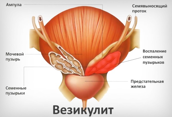Азооспермия. Что это такое, лечится или нет