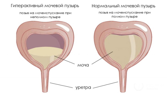 Цистит у детей. Симптомы и лечение в домашних условиях