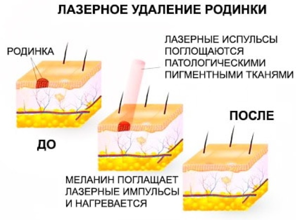 Родинка чешется. Причины у женщины, что делать