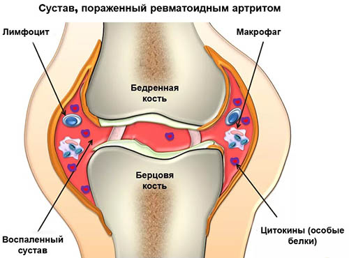 Остеопороз коленного сустава 1-2-3 степени. Симптомы, лечение