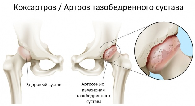 Боль в ягодице слева отдающая в ногу, справа. Что это, причины при сидении, ходьбе, вставании