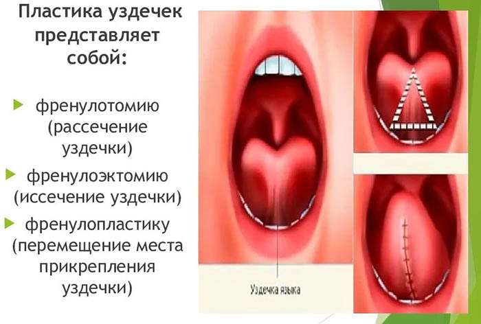 Уздечка языка. Что это такое, где находится, как выглядит у человека