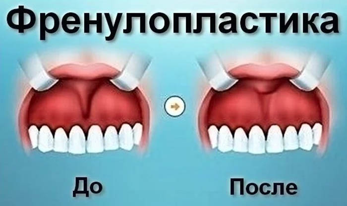 Уздечка языка. Что это такое, где находится, как выглядит у человека