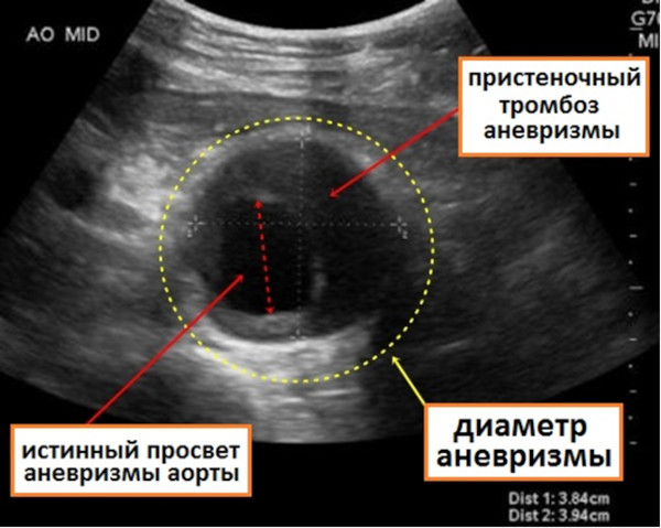 УЗИ аорты брюшной полости. Подготовка к исследованию