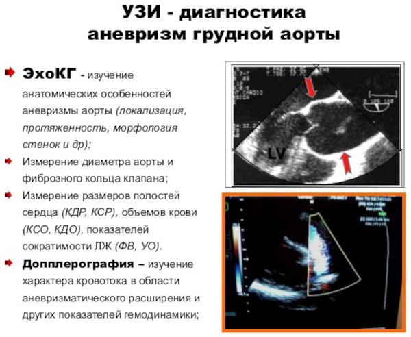 УЗИ аорты брюшной полости. Подготовка к исследованию