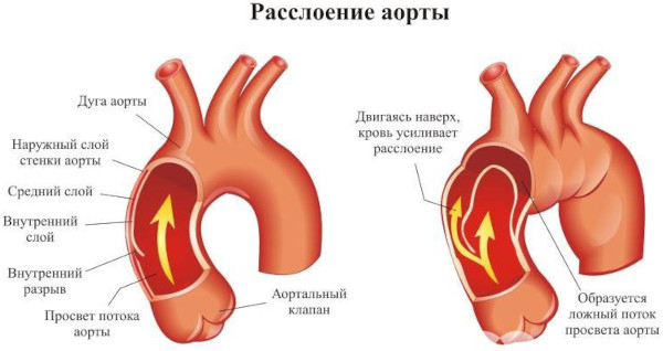 УЗИ аорты брюшной полости. Подготовка к исследованию