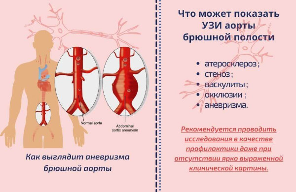 УЗИ аорты брюшной полости. Подготовка к исследованию