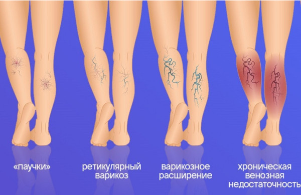 УЗИ сосудов ног. Что показывает, как делают