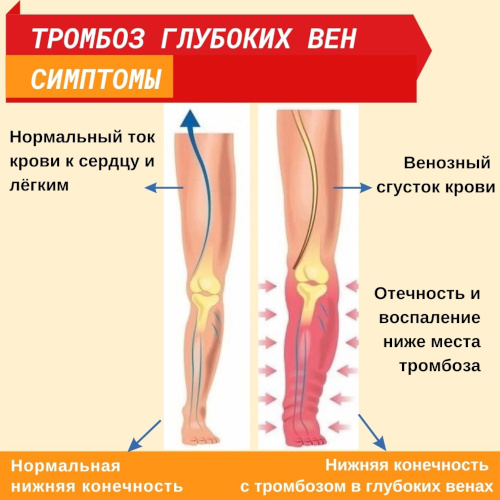 УЗИ сосудов ног. Что показывает, как делают