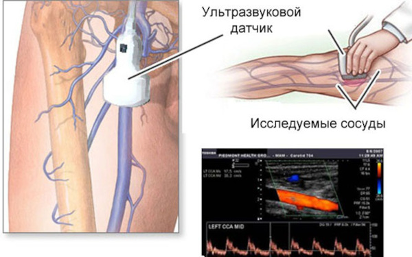 УЗИ сосудов ног. Что показывает, как делают