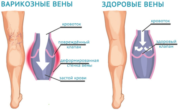 УЗИ сосудов ног. Что показывает, как делают