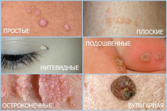 Радиоволновое удаление новообразований кожи, дефектов. Что это такое