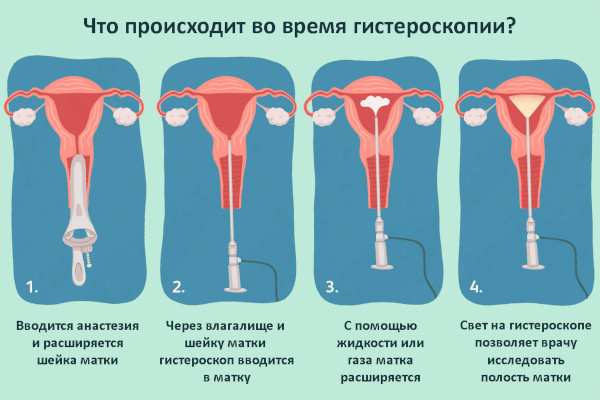 Влагалищная экстирпация матки. Ход операции