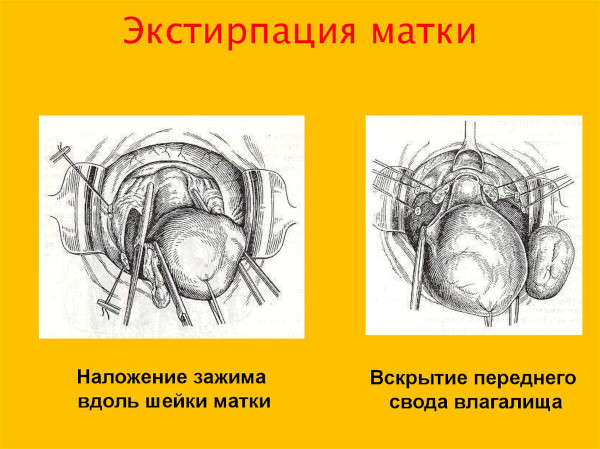 Влагалищная экстирпация матки. Ход операции