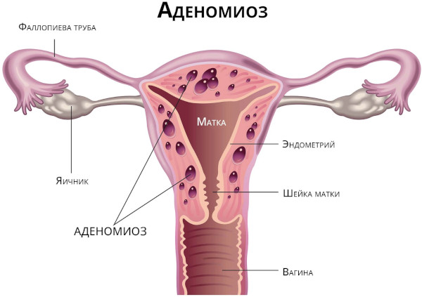 Влагалищная экстирпация матки. Ход операции