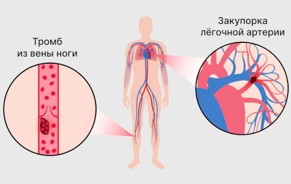 Влагалищная экстирпация матки. Ход операции