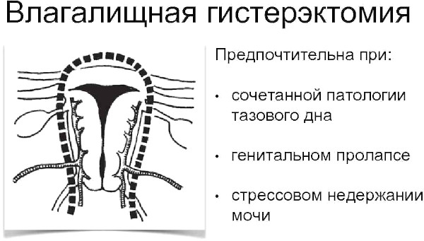 Влагалищная экстирпация матки. Ход операции