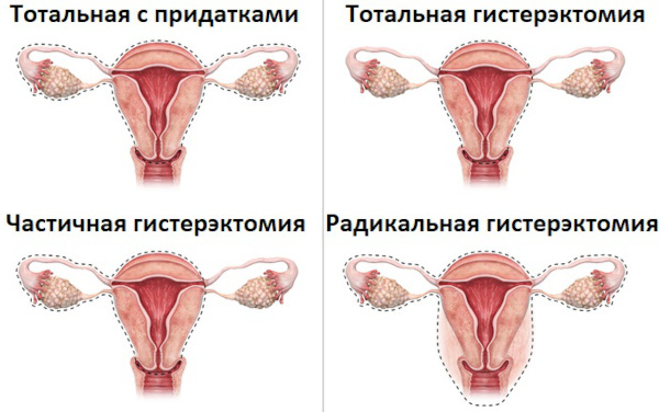 Влагалищная экстирпация матки. Ход операции