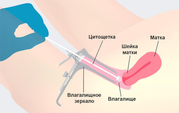 Влагалищная экстирпация матки. Ход операции