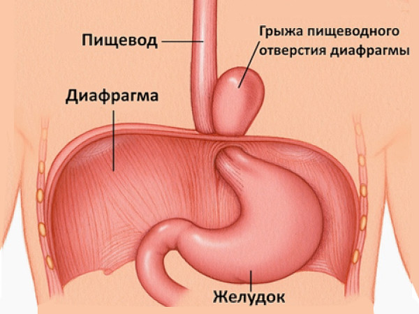 Влагалищная экстирпация матки. Ход операции