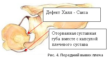 Вывих плечевого сустава. Лечение, реабилитация, упражнения, симптомы, первая помощь, рентген