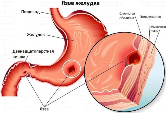 Цефтазидим уколы. Инструкция по применению взрослым