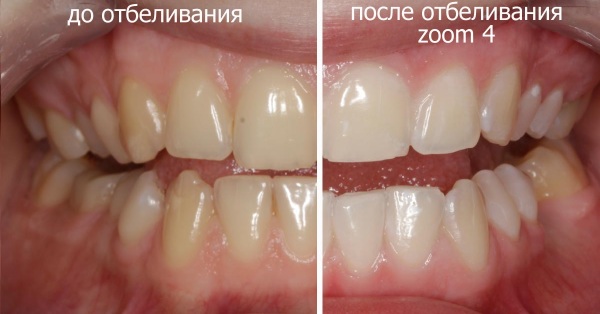 Отбеливание Зум 4 (Zoom 4). Что это такое, инструкция, отзывы, цена