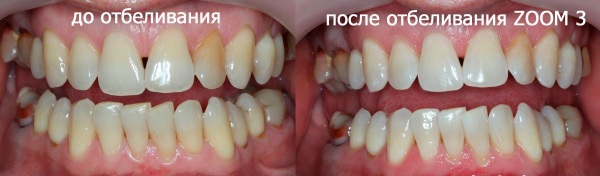 Отбеливание Зум 4 (Zoom 4). Что это такое, инструкция, отзывы, цена