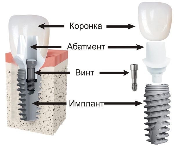 Абатменты для имплантов. Что это такое, где купить, виды, цена