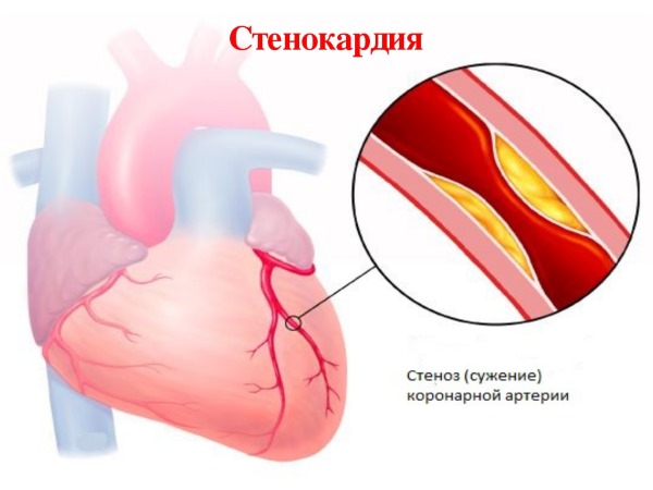 Аконит: показания к применению гомеопатии в народной медицине. Инструкция, как приготовить и принимать настойку